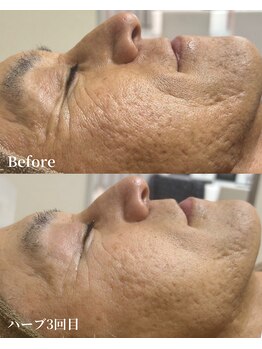 エース(ACE.)/くすみ・小じわ改善☆