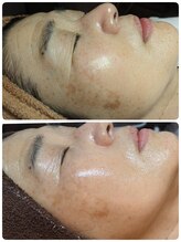 ウララ(ulala)/ララピール＋シミケア