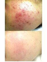 サロンドエステケイワイ(de KY)/フェイシャル☆ニキビ改善