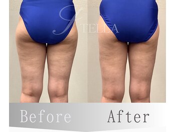 ステラ(STELLA)/下半身プレミアムの効果