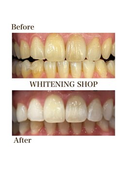 ホワイトニングショップ 銀座7丁目店(WHITENING SHOP)/Before After