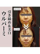 小顔ウナ学芸大学店(UNA)/ウルパーミ☆ビフォアアフター