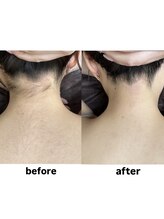 ミスターアンドミス 四ツ橋 堀江店(Mr.&Ms.)/レディースうなじ脱毛