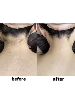 ミスターアンドミス 四ツ橋 堀江店(Mr.&Ms.)/レディースうなじ脱毛