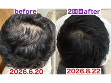 サロンノコ(salon NOKO)の雰囲気（フェイシャル1回の変化｜ヒト幹細胞導入）