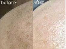 スリー(THREE)/都度払い脱毛【THREE】