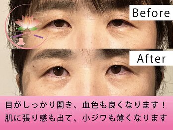 健美庵/本格美容鍼