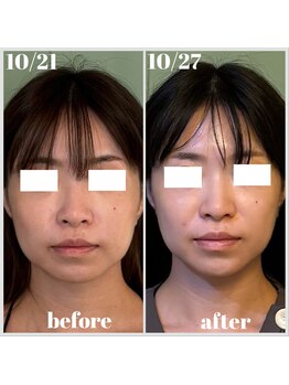 グロウズ(Glows)/小顔&たるみ改善