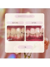 プラスビーセルフ(+b self)/ホワイトニングビフォーアフター