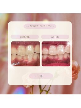 プラスビーセルフ(+b self)/ホワイトニングビフォーアフター