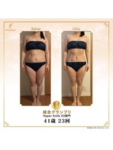 アチェリー(aCherry)/ハイパーナイフ痩身