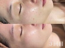 ホワイトアクア 姫路店(WHITE AQUA)/ハーブピーリング/ニキビケア