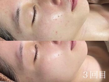 ホワイトアクア 姫路店(WHITE AQUA)/ハーブピーリング/ニキビケア