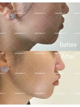 ナラビューティー(NARA BEAUTY)/韓国最新オンタリフト導入！