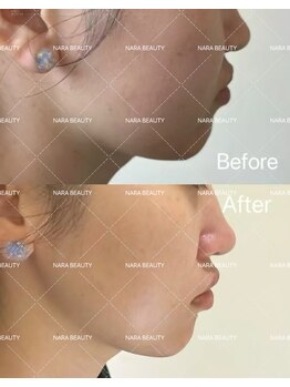 ナラビューティー(NARA BEAUTY)/韓国最新オンタリフト導入!