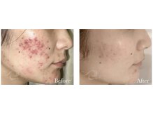 メルシー(merci)/ハーブピーリング