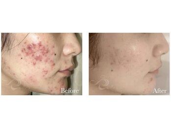 メルシー(merci)/ハーブピーリング