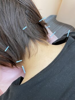 すみだバランス鍼灸整骨院 押上本院/首の痛みや頭の重さや痛みに