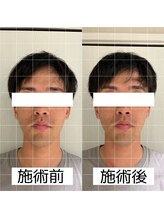 ヴィーライン 大阪梅田院(VeLine)/鍼灸／美容鍼／小顔／大阪／梅田