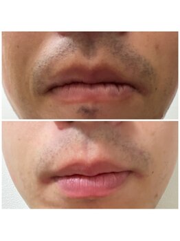 ナチュールムーン(Nature moon.)/男性　髭脱毛