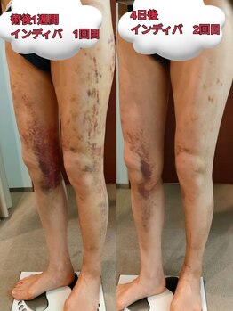 ビューティーエッセンス 都立大学(BEAUTY ESSENCE)/ダウンタイム