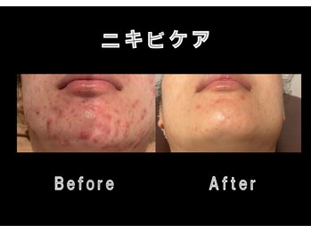 エステティック レイビス 銀座店(RAYVIS)/ホワイトスノーピール×ハーブ