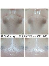 ベルクラージュ(Belle Courage)/20代　毛穴・ざらつき