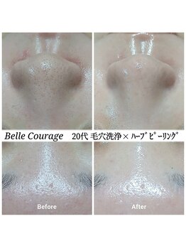 ベルクラージュ(Belle Courage)/20代　毛穴・ざらつき