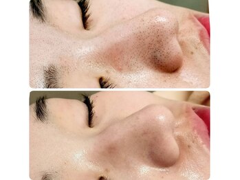 庭夢エステの写真/【夏の肌悩みを即効解消】ザラつき、黒ずみ毛穴、皮脂や紫外線ダメージでの毛穴の目立ち、くすみを改善
