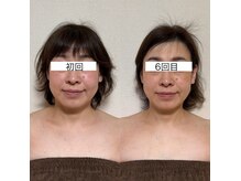 No.3(three)の雰囲気（骨から整えるので立体感のある小顔へ！頬骨位置が上がります♪）