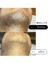 エスト(Est_.)/美容電気脱毛【レーザー硬毛化】