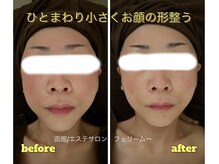 フェリームー(feerie mu)/【たるみケア・小顔リフト】