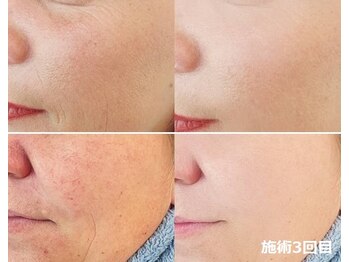 ナチュレアンドメディカ(Nature&Medica)/顔脱毛+赤ら顔ケアフェイシャル
