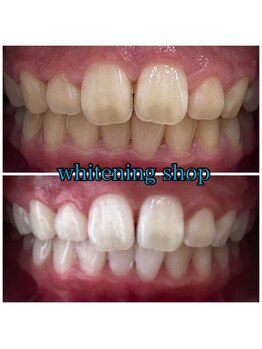 ホワイトニングショップ 日進店/Before After日進ホワイトニング