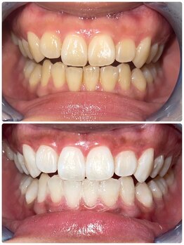 エクシアホワイトニング 町田店/ホワイトニングビフォーアフター