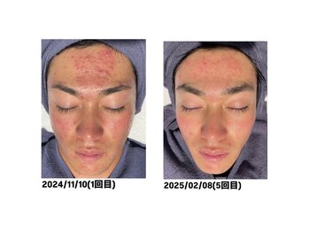 オーシャンブルー 大分店(OCEAN BLUE)/グロウパールピーリング　症例