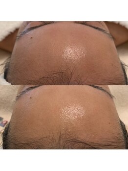 ブリス(Bliss)/白玉酸素でくすみよサヨナラ