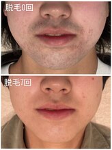 ユニセックスサロン アンシェル(UNISEXSALON UNCHEL)/ヒゲ脱毛【都度払い3,300円】