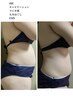 痩身お腹周り。キャビテーション　ラジオ波　マッサージ　EMS