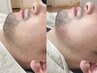 ヒゲwax脱毛（鼻下/あご/あご下&首から1部位）