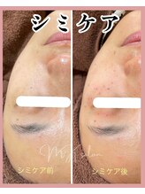 エムケーサロン(MK salon)/シミケア施術前後
