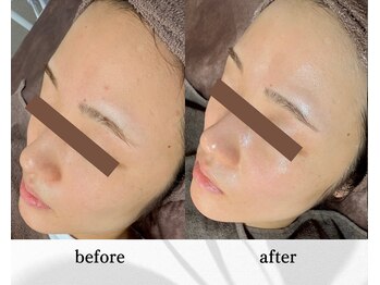 アン ビューティー(ann beauty)/施術2回【症例写真】20代女性