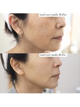 エクレクティック(ECLECTIC)/小顔/リフトアップ