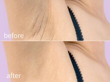 ソレイユ(Soleil)/ムダ毛・美肌