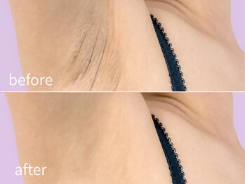 ソレイユ(Soleil)/ムダ毛・美肌