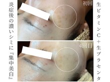 シストワ(sistoi)の雰囲気（高濃度ビタミンCポレーション導入＆20日間のホームケアで改善！）