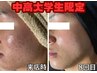 【U24学割】思春期ニキビこそプロにおまかせ!集中ケア★ハーブピーリング