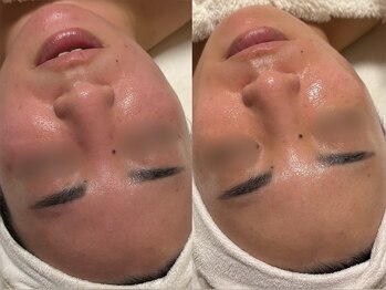 TEN Aesthetic【艶肌・肌質改善・五臓漢方よもぎ蒸し】【7/2　NEW　OPEN（予定）】/乾燥や肌荒れによる赤みの改善