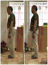 カイロプラクティック コダマ(KODAMA)/姿勢矯正ビフォーアフター