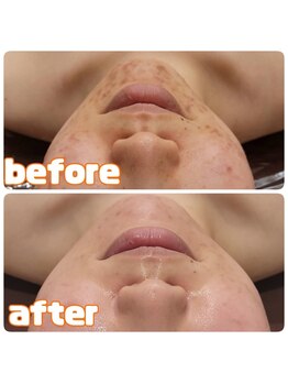 エステティックレイビス 名古屋店(RAYVIS)/大人気ハーブピーリング♪